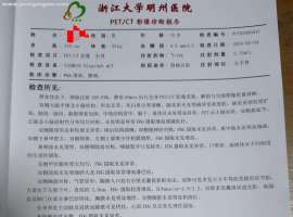 前列腺癌肺转骨转